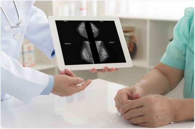 Mammography Mammography