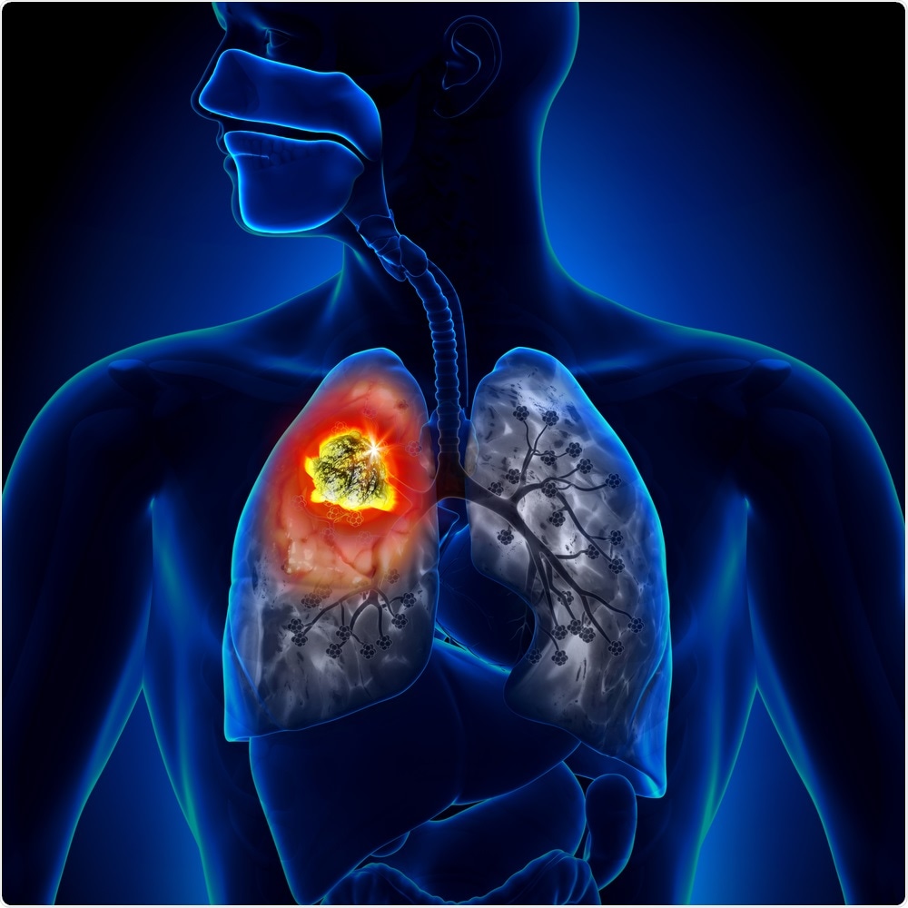 Lung Cancer Lung Cancer