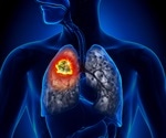 Clinical lipidomics in understanding of lung cancer: Opportunity and challenge