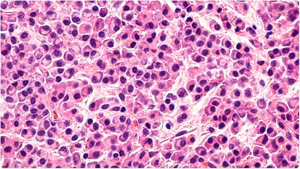 Multiple Myeloma Multiple Myeloma
