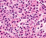 Applying integrated lipidomics and proteomics in multiple myeloma reveals potential disease pathways
