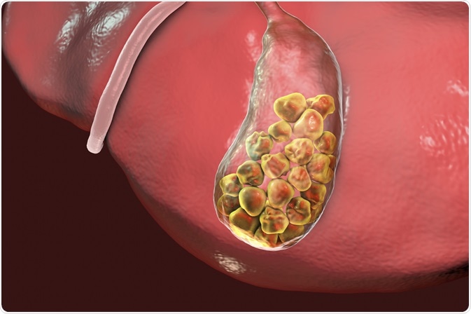 Gallstones Gallstones