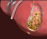 Immune System and Gallstones