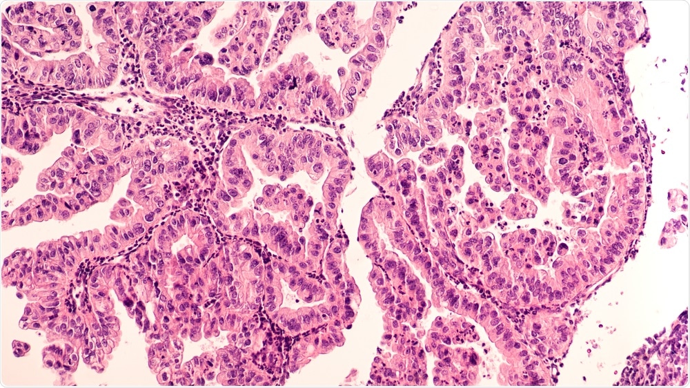 Ovarian Cancer