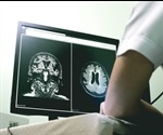 Neuroprotective Drugs: Future Developments in Treating Vascular Dementia
