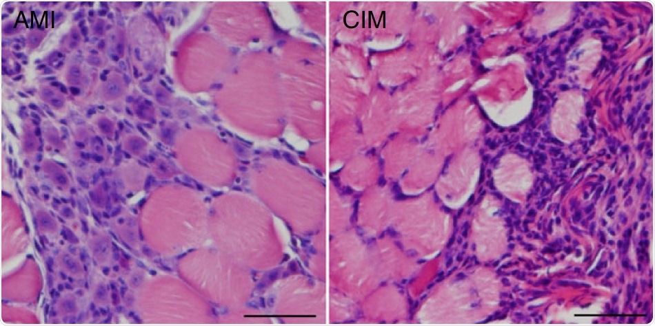 Patients with chronic myopathy can benefit from cell-aging drug and exercise