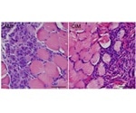 Patients with chronic myopathy can benefit from cell-aging drug and exercise