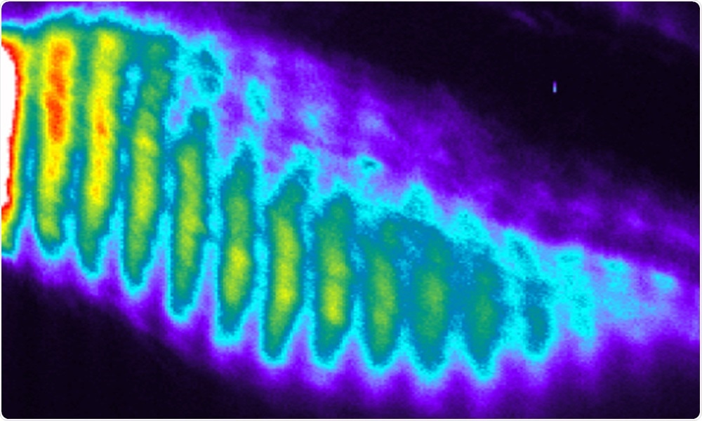 Study examines molecular causes of spondylocostal dysostosis