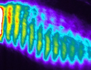 Study examines molecular causes of spondylocostal dysostosis
