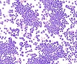 Immune System Changes Occur Early In Development Of Multiple Myeloma
