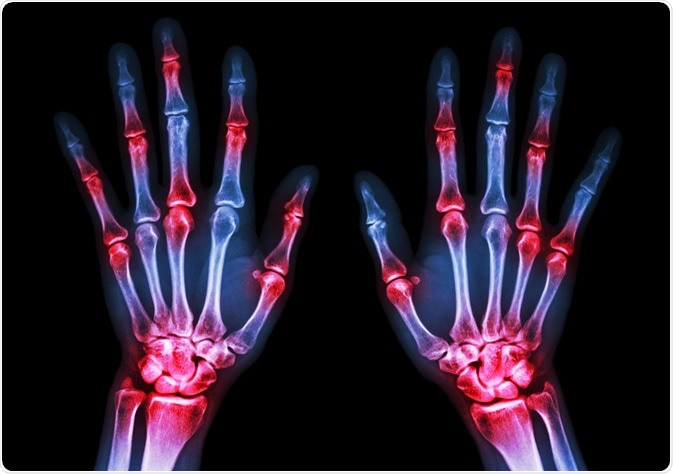 Rheumatoid Arthritis Rheumatoid Arthritis