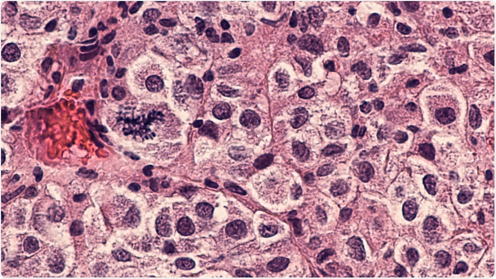 Melanoma Melanoma