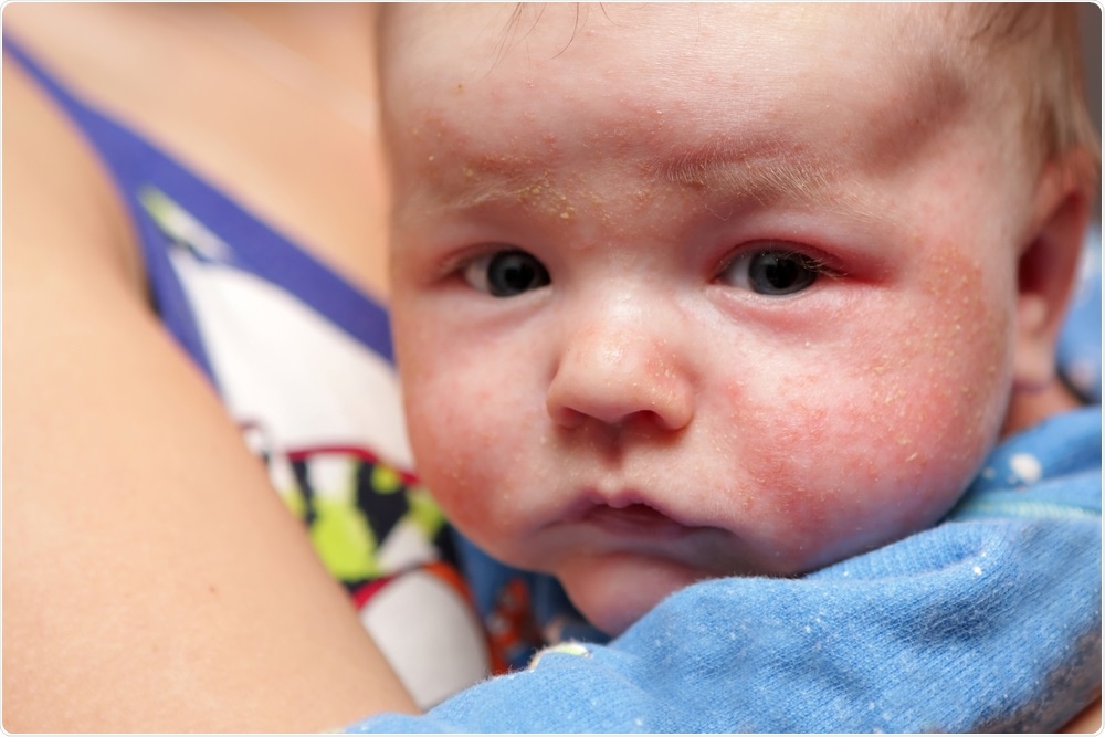 Baby with Eczema Baby with Eczema