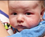 Gene Defects Linked To Eczema, Wheeze And Nasal Disease Among Babies