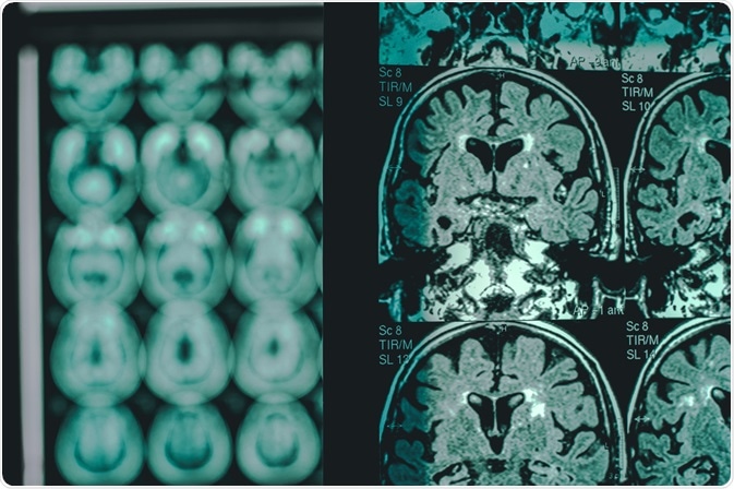 Alzheimers Disease Alzheimers Disease