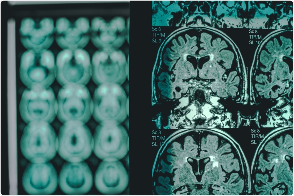 Alzheimers Disease Alzheimers Disease