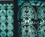 Scientists Discover Gene That Increases Risk Of Alzheimer's Disease