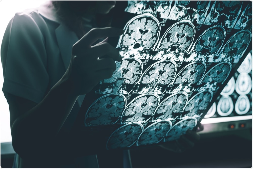 Alzheimers Disease Alzheimers Disease