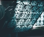 Gene Variant Staves Off Alzheimer's In Some People