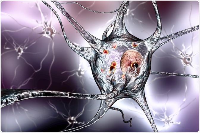 Parkinsons Disease Parkinsons Disease