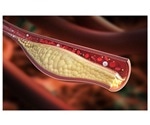 Study reveals new gene that regulates cholesterol levels