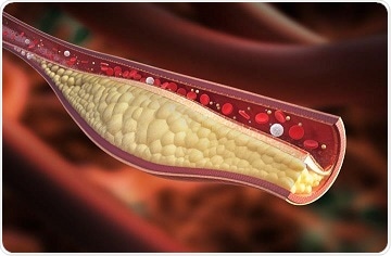 Study reveals new gene that regulates cholesterol levels