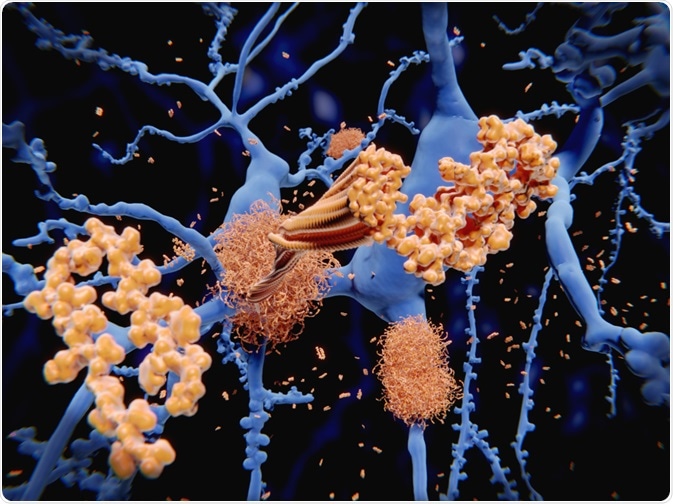 Alzheimers Disease