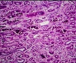 Study discovers race-specific lupus nephritis biomarkers for early diagnosis and treatment