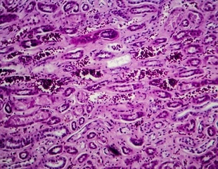 Study discovers race-specific lupus nephritis biomarkers for early diagnosis and treatment