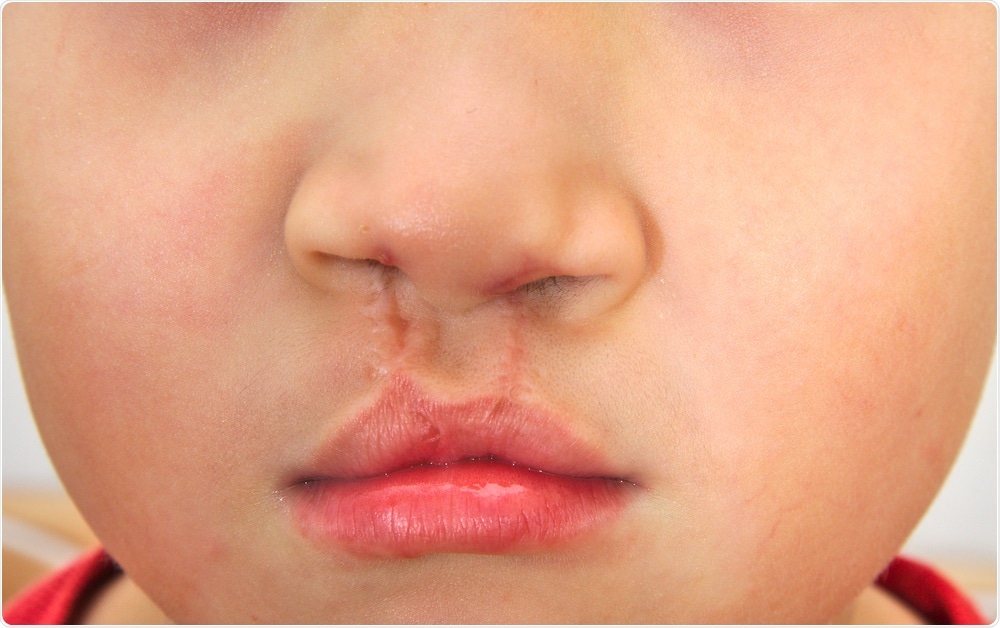 Child with Cleft Lip Child with Cleft Lip