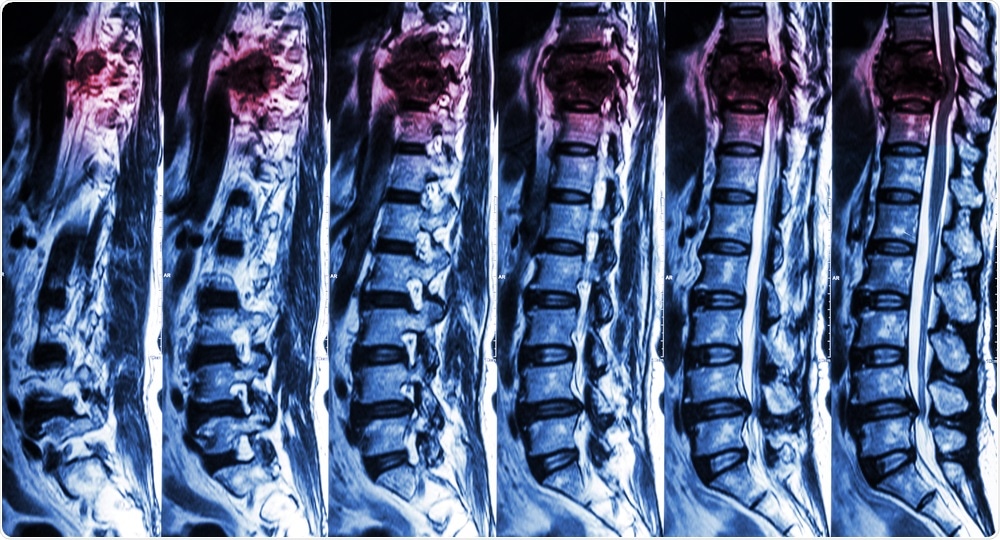 Spinal Cord Injury Spinal Cord Injury