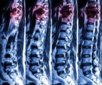 Spinal Cord Injuries: Finding Better Treatments