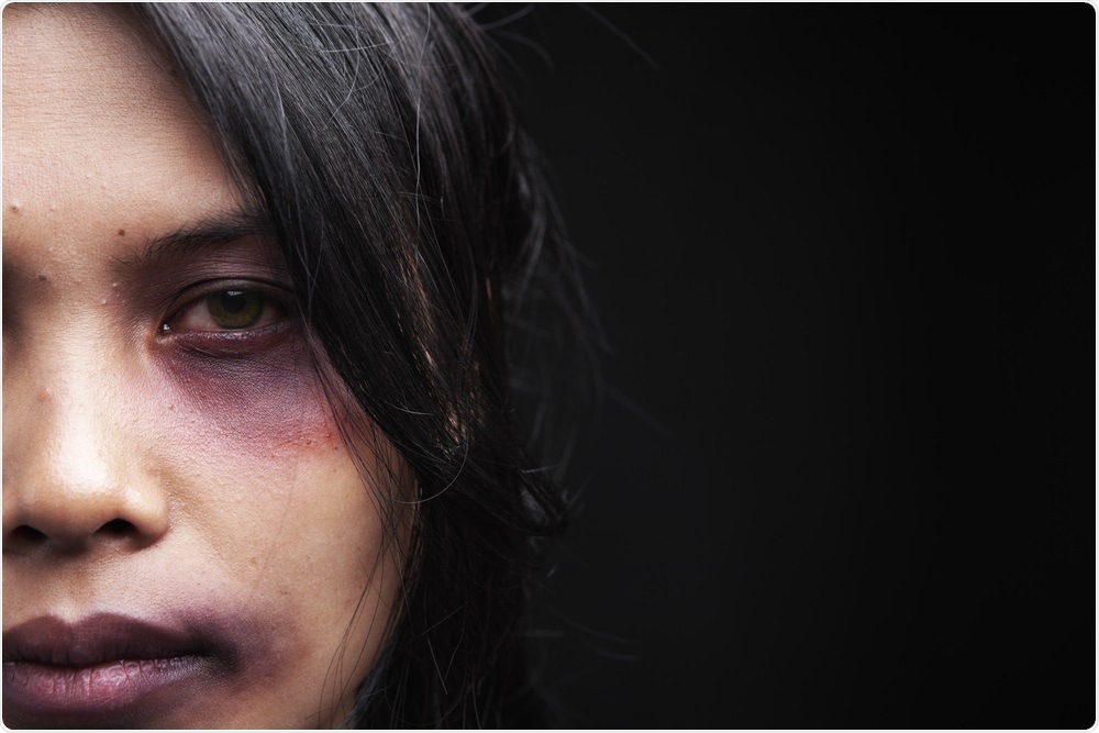 Woman with Bruises Woman with Bruises