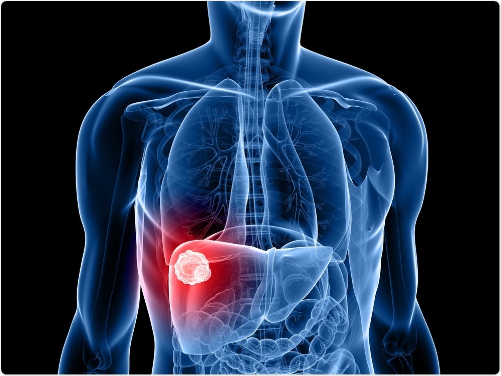 Liver Tumor Liver Tumor