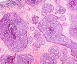 Blood Cells Could Serve As A 'Thermometer' To Detect Breast Cancer