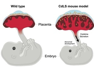 Dysfunctional placenta can contribute to Cornelia de Lange syndrome