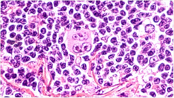 Hodgkin’s Lymphoma Hodgkin’s Lymphoma