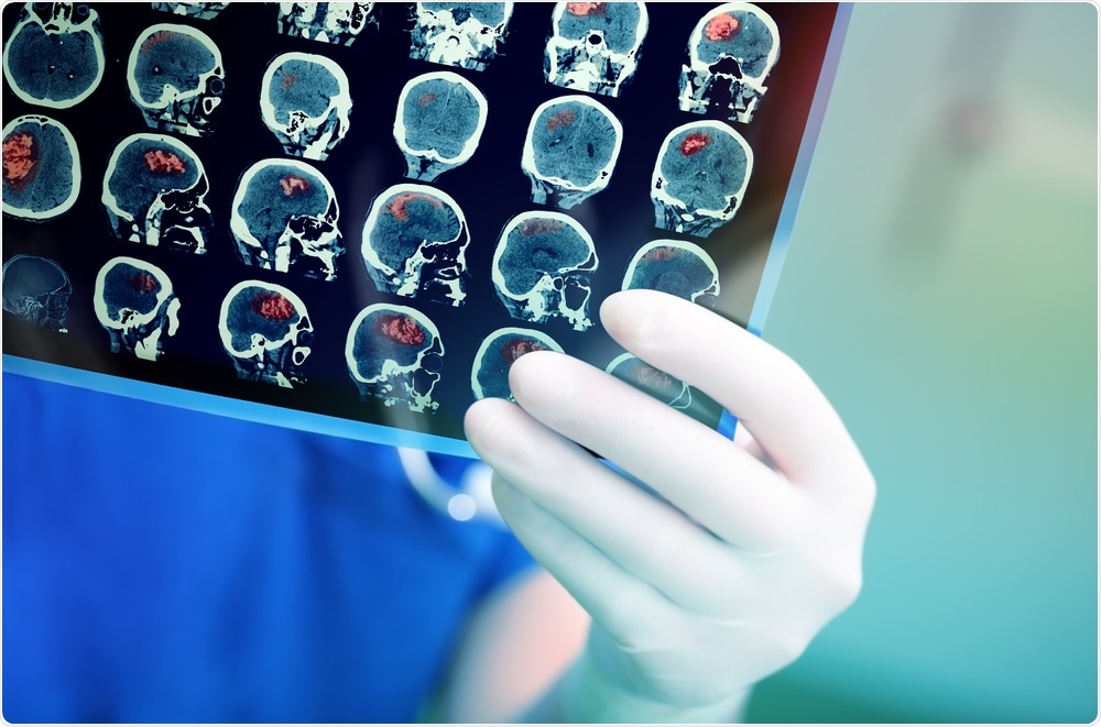 Brain Tumor