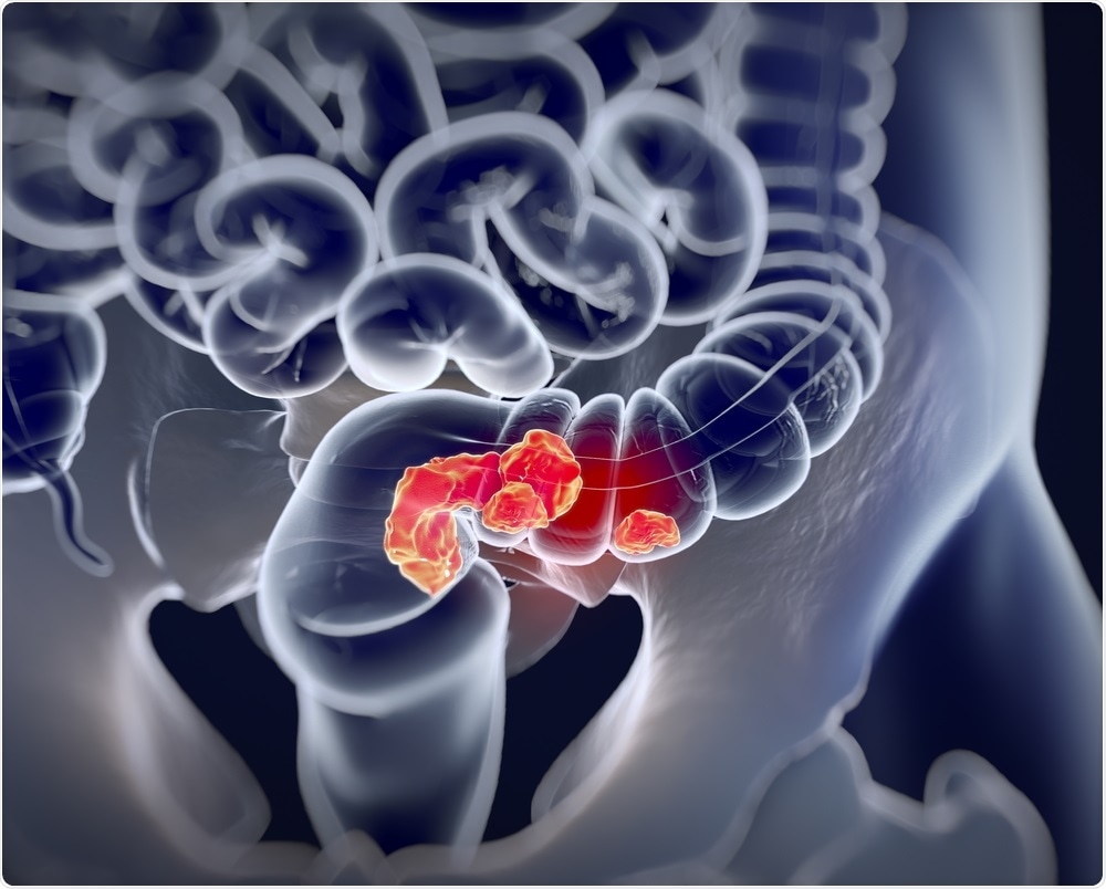 Colorectal Cancer Colorectal Cancer