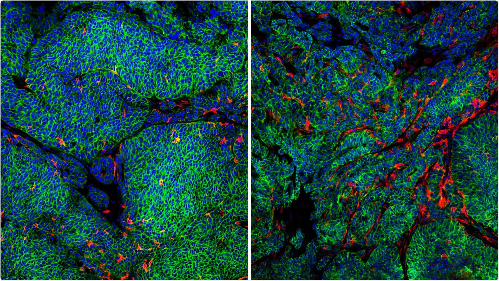 Study shows how breast cancer cells escape the immune system