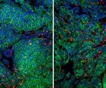 Study shows how breast cancer cells escape the immune system