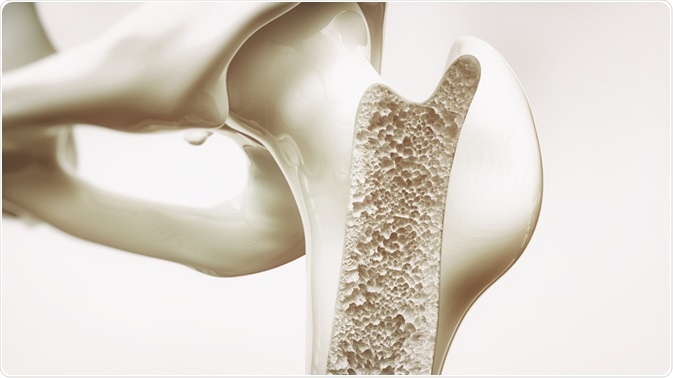 Osteoporosis Osteoporosis