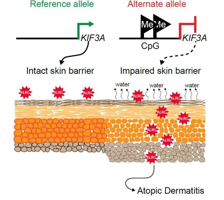Study sheds light on genetic and molecular mechanisms involved in atopic dermatitis