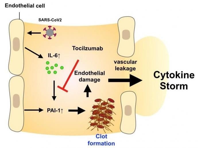 Researchers identify an effective treatment for severe cases of COVID-19 infection