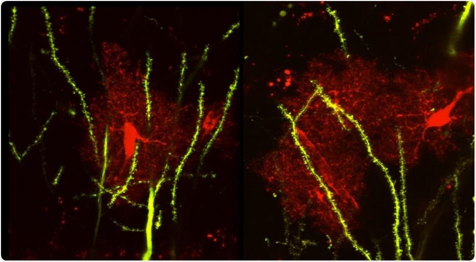 Researchers identify brain protein that leads to seizures and abnormal social behaviors