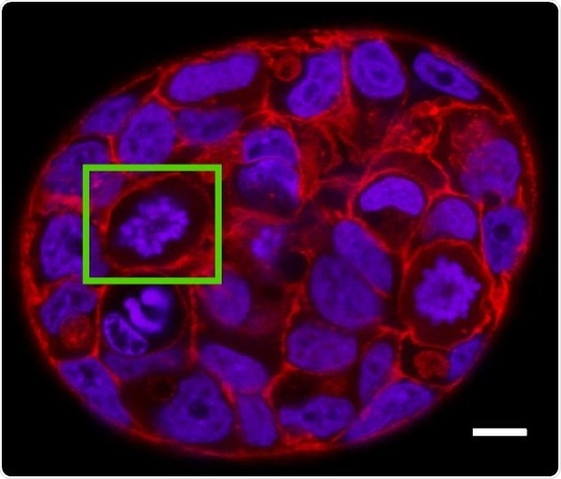 Study shows how tumor cells gain enhanced ability to deal with crowded tumor environment