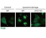 Study reveals pathways essential for preventing crystal-induced kidney injury