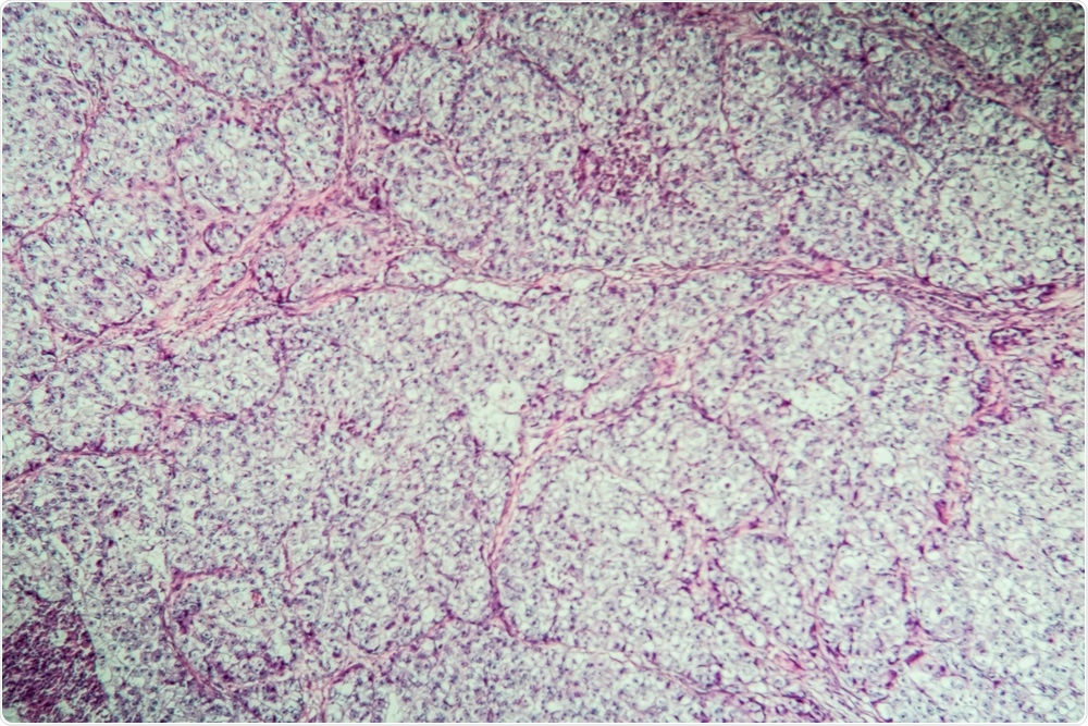 ovarian carcinoma ovarian carcinoma