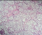 Study pinpoints specific genes that cause ovarian cancer
