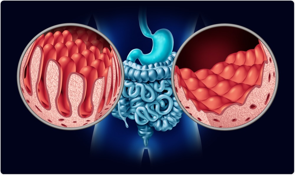 Coeliac Disease Coeliac Disease